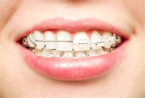 You may also be curious about just how long a single most patients are instructed to wear clear retainers full time for a couple of months, and then followed by night time wear after that. Which is better retainers or braces? | Studio Dentaire