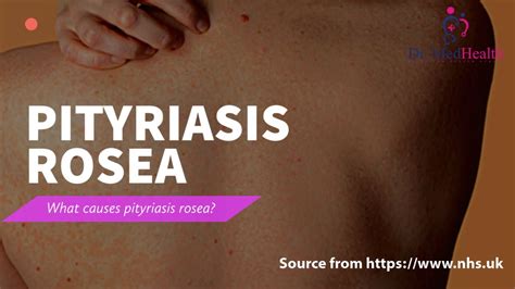 All About Pityriasis Rosea Causes Symptoms Pityriasis Pityriasis