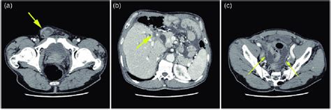 Abdominal Computed Tomography Shows A Heterogeneous Cystic And Solid