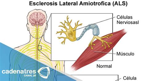 neurólogos explican qué es la esclerosis lateral amiotrófica youtube