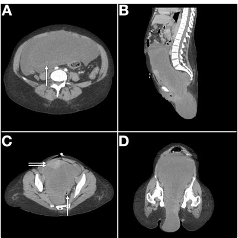 A Axial Contrast Enhanced Computed Tomography Images Shows Subtle Download Scientific Diagram
