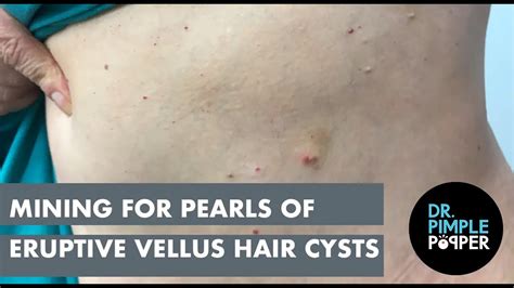 Mining For Pearls Of Eruptive Vellus Hair Cysts Youtube