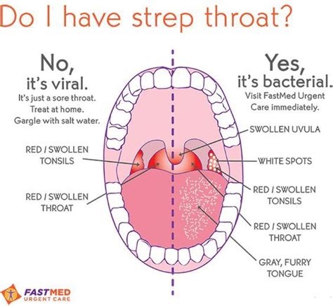 Is It Strep Throat Or Not Good Diagram Explaining A Viral Infection Vs