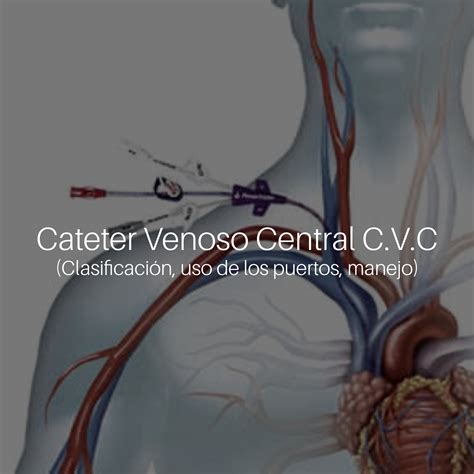 Catéter Venoso Central Cvc