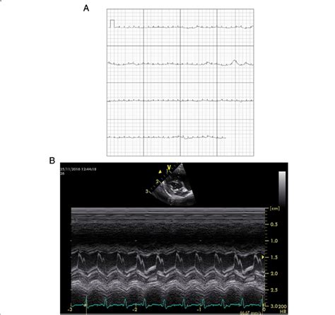 A Electrocardiographic Examination Of A Clinically Healthy And