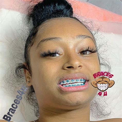 Fashion Braces Discount 💞 This Week Trendy Braces Ja