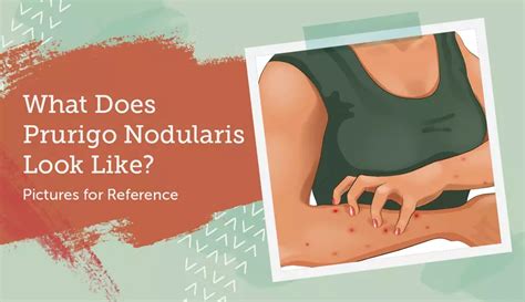 What Does Prurigo Nodularis Look Like Pictures For Reference