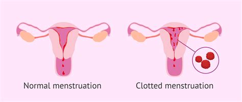 Why Do Blood Clots Occur During Menstruation