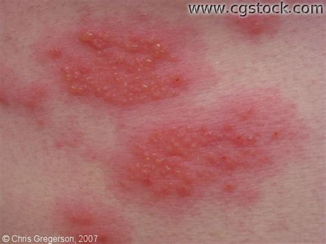 Allergic contact dermatitis and irritant contact dermatitis share many similar clinical features, even though the latter is more common; Contact Dermatitis. Causes, symptoms, treatment Contact ...
