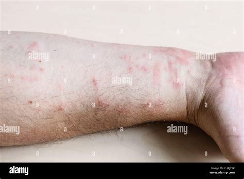 Sample Of Allergic Contact Dermatitis Skin Inflammation On Inner Side