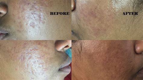 Dermarolling For Acne Scars Your Ultimate Guide Martlabpro