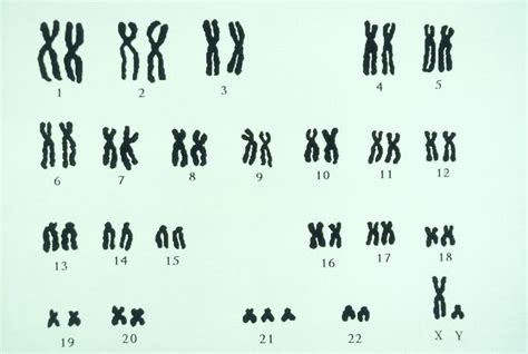 9 Rare Genetic Trisomies Beyond Down Syndrome