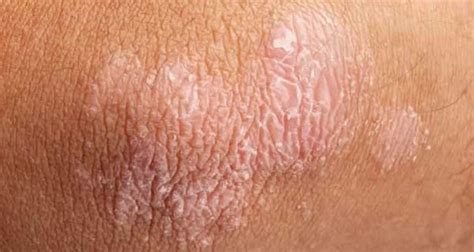 Beware Your Skin Rash Could Be Pointing To A Health Issue