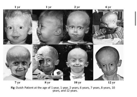 Oren Gottfried Md On Twitter Hutchinsongilford Progeria Syndrome