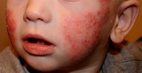 La Dermatitis Atópica Afecta A Más Del 50 De Los Niños Que Visitan A