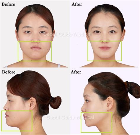 Before And After Double Jaw Surgery Seoul Guide Medical