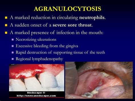 Ppt Oral Manifestations Of Systemic Diseases Powerpoint Presentation