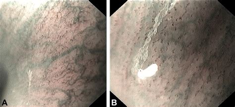 Narrow Band Imaging Magnifying Endoscopy In Adult Patients With