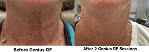Genius Rf Microneedling Before And After Photos Patient 18 Washington Dc Mi Skin Dermatology