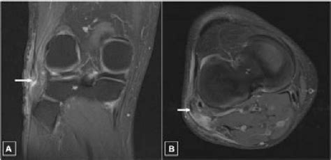 Figure 4 From Isolated Complete Distal Biceps Femoris Tendon Tears