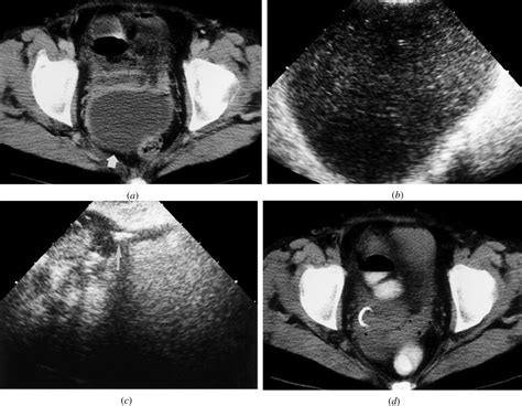 Ultrasound Guided Endocavitary Drainage Of Pelvic Abscesses Technique