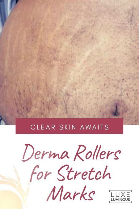Derma Roller For Stretch Marks Microneedling Treatments Luxe Luminous