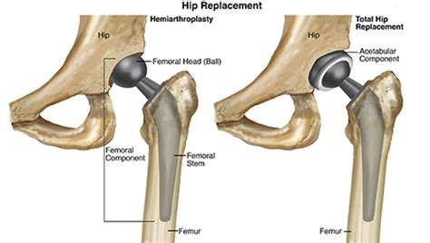 hip replacements a brief history buxton osteopathy clinic