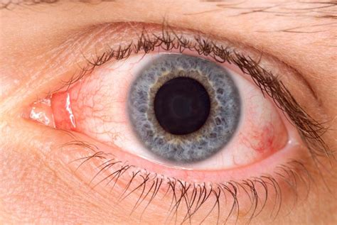 A Man Discovered A Pus Filled Pseudomembrane In His Eye After Getting