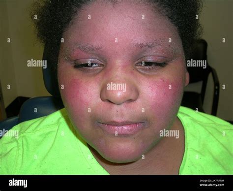 Atopic Dermatitis On The Face Of An African American Girl Atopic