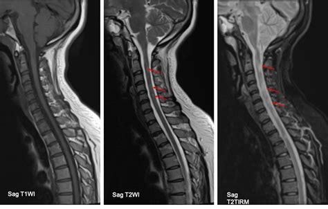 Multiple Sclerosis Radiology Cases