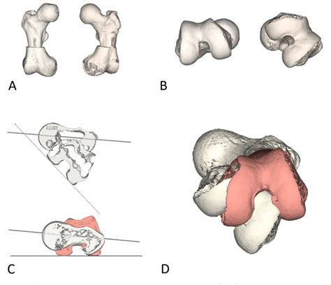 Figure 1 From Custom 3D Printed Cutting Guides For Femoral Osteotomy In