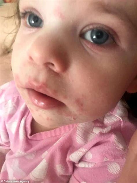 Two Year Old Was Covered In A Deadly Rash After A Virus Entered Her