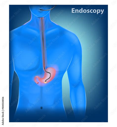 3d Vector Illustration Of A Endoscopy Of The Stomach Gastroscopy