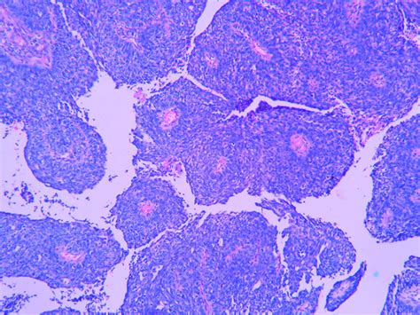 Basaloid Squamous Cell Carcinoma Histopathologyguru