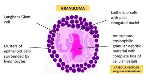 Granulomatous Inflammation Pathology Made Simple