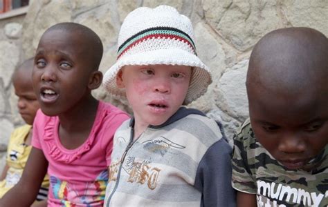 Albino Children Hunted And Mutilated In Africa Receive New Limbs In