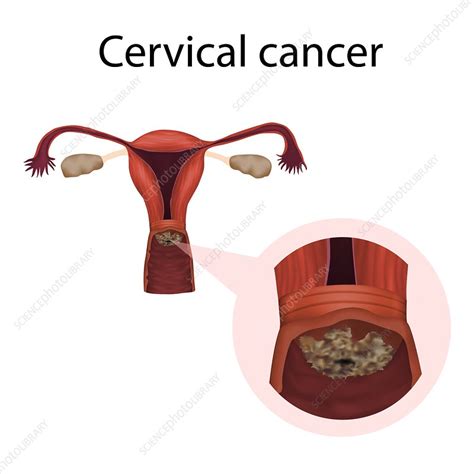 Cervical Cancer Illustration Stock Image F Science Photo Library