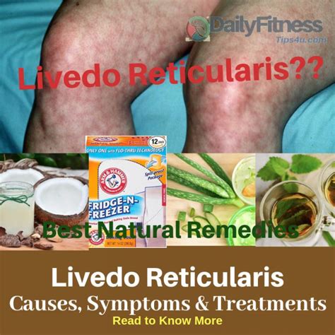 Livedo Reticularis Causes Picture Symptoms And Treatments