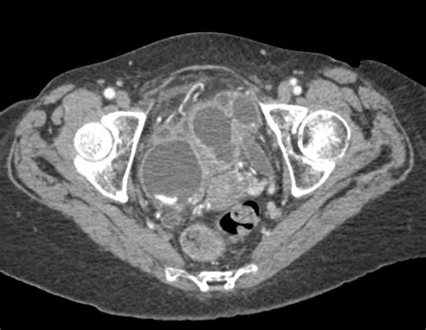 Tubo Ovarian Anatomy