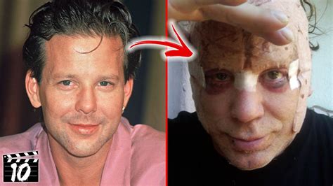 mickey rourke plastic surgery before and after