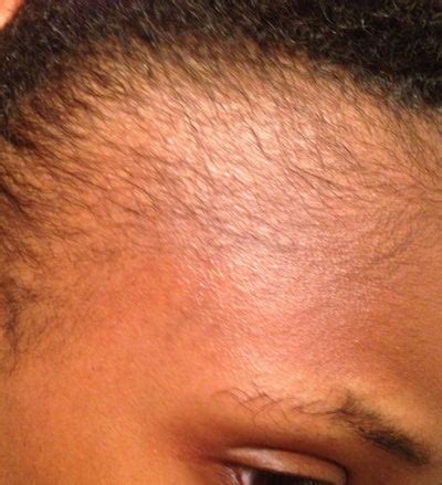 Alopecia areata (aa), a nonscarring type of hair loss, is the most prevalent autoimmune disease, with a lifetime prevalence of 1.7%. Would cortisone injections be an option for my hair loss ...