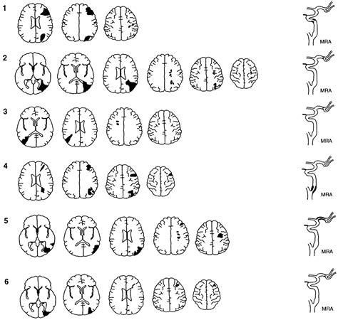 It is the sudden impairment of cerebral circulation in one or more of the blood vessels supplying the brain. Atherothrombotic Middle Cerebral Artery Territory ...