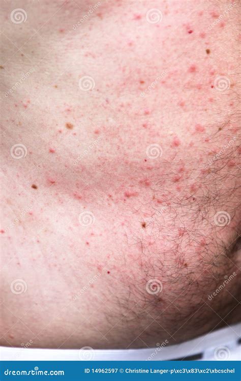 Rash Or Sun Allergy Stock Image Image Of Allergy Acne 14962597