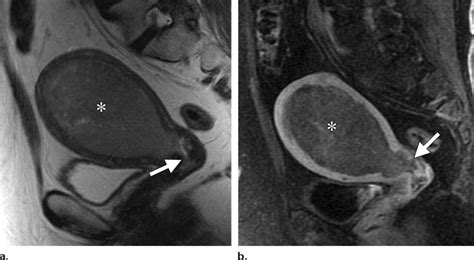 Stage Ii Endometrial Cancer In A 64 Year Old Woman A Sagittal