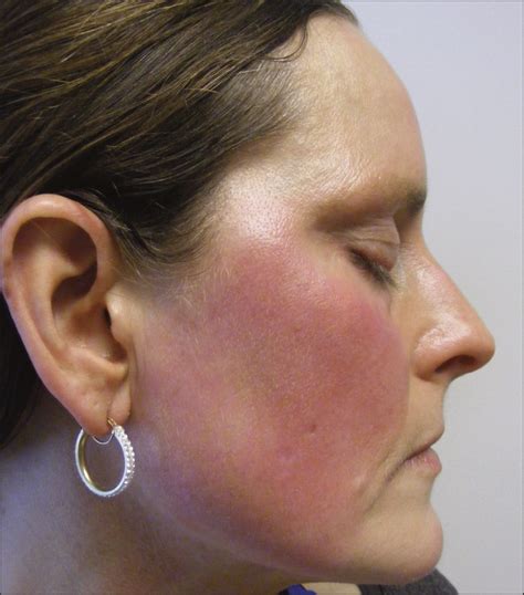 Neurogenic Rosacea A Distinct Clinical Subtype Requiring A Modified