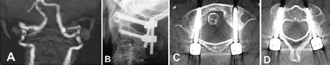 C1 Lateral Mass And C2 Pedicle Screw Fixation Goel Harms Method A