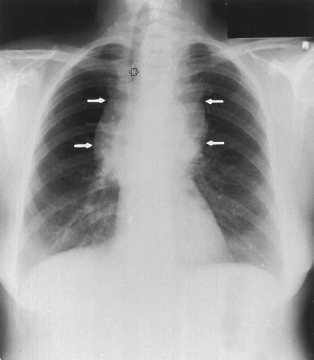 Posteroanterior Chest Radiograph A Large Intrathoracic Goiter Arrows