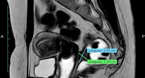 Disc Excision In Large Deep Endometriosis Nodule Of Low Rectum Full Time Transanal Step The