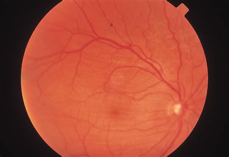 Frontoethmoidal Mucoceles Causing Bilateral Chorioretinal Folds