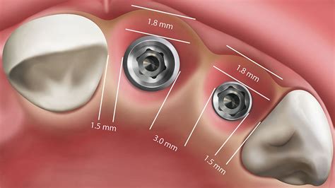 Im0502 Implant Esthetic Zone 01